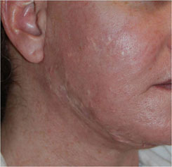 Acne Scar Treatment Before & After Photo