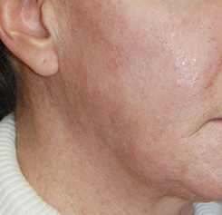 Acne Scar Treatment Before & After Photo