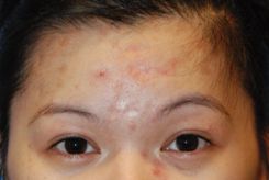 Acne Scar Treatment Before & After Photo