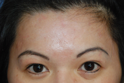 Acne Scar Treatment Before & After Photo