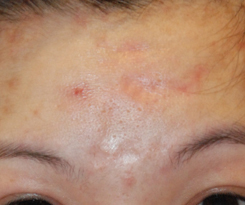 Acne Scar Treatment Before & After Photo