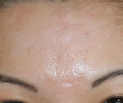 Acne Scar Treatment Before & After Photo