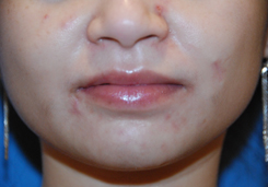 Acne Scar Treatment Before & After Photo