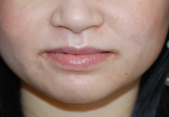 Acne Scar Treatment Before & After Photo