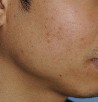 Acne Scar Treatment Before & After Photo