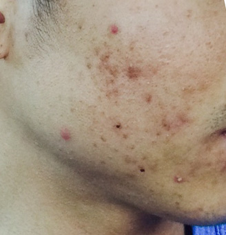 Acne Scar Treatment Before & After Photo