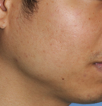 Acne Scar Treatment Before & After Photo