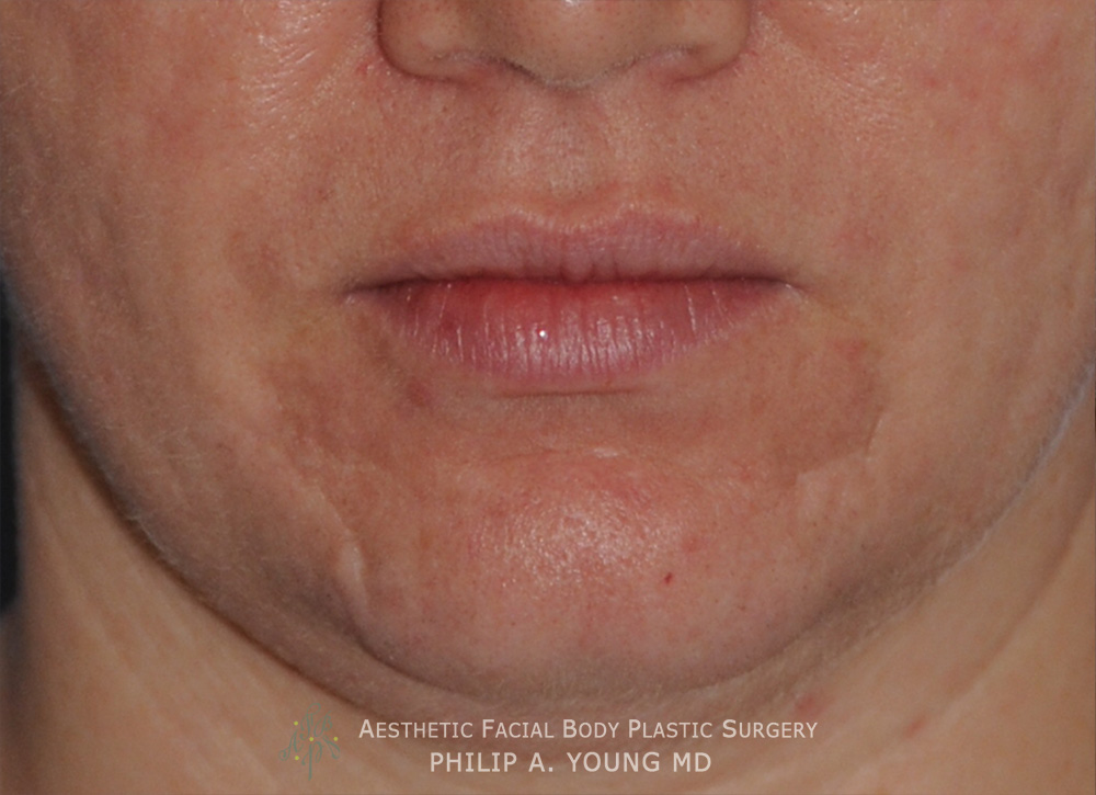 Acne Scar Treatment Before & After Photo