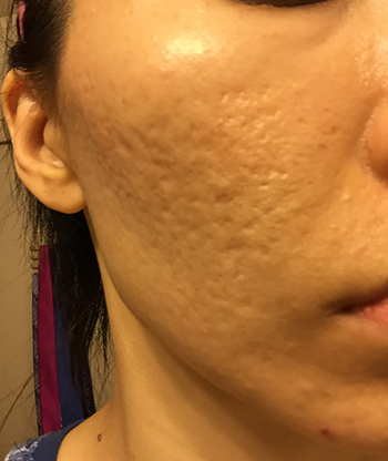 Acne Scar Treatment Before & After Photo