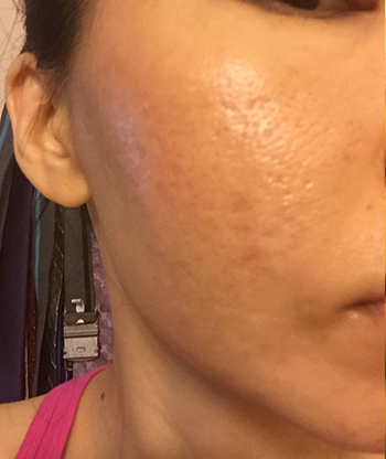 Acne Scar Treatment Before & After Photo