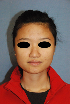 Asian Rhinoplasty Before & After Photo