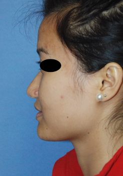 Asian Rhinoplasty Before & After Photo