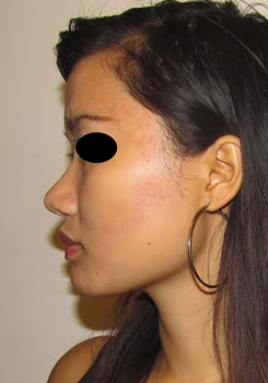 Asian Rhinoplasty Before & After Photo