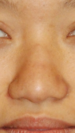 Asian Rhinoplasty Before & After Photo