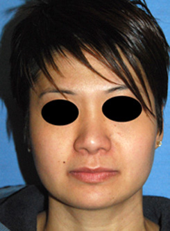 Asian Rhinoplasty Before & After Photo