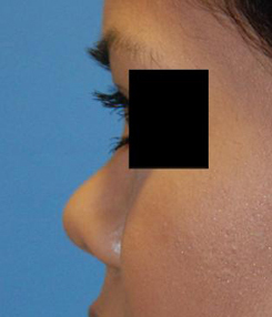 Asian Rhinoplasty Before & After Photo