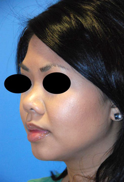 Asian Rhinoplasty Before & After Photo