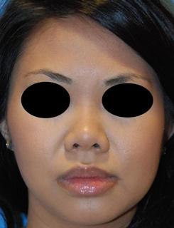 Asian Rhinoplasty Before & After Photo