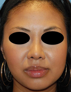 Asian Rhinoplasty Before & After Photo