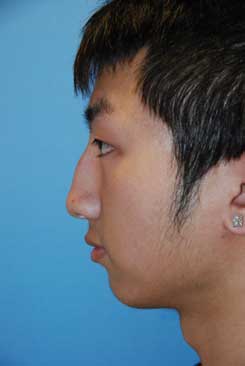 Asian Rhinoplasty Before & After Photo