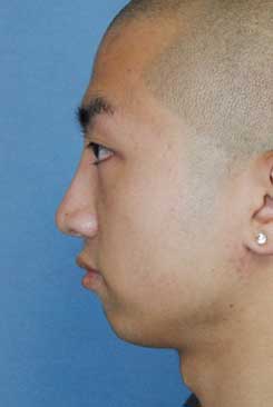 Asian Rhinoplasty Before & After Photo