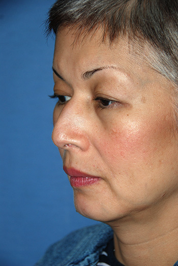 Asian Rhinoplasty Before & After Photo