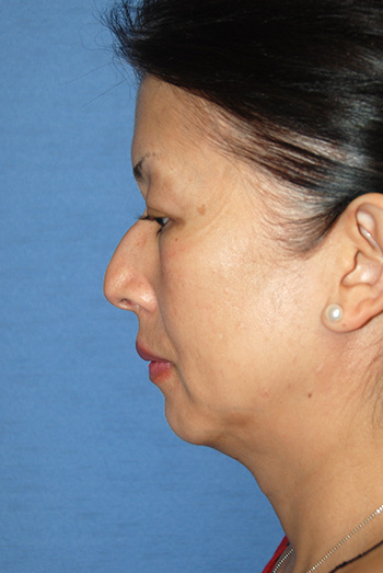 Asian Rhinoplasty Before & After Photo