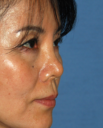 Asian Rhinoplasty Before & After Photo