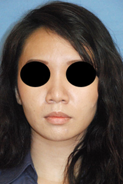 Asian Rhinoplasty Before & After Photo