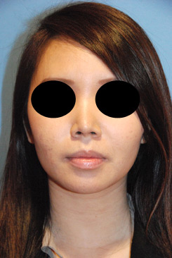 Asian Rhinoplasty Before & After Photo