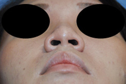 Asian Rhinoplasty Before & After Photo