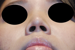 Asian Rhinoplasty Before & After Photo