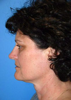 Cheek Implant Before & After Photo