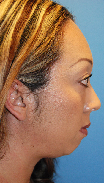 Chin Implant Before & After Photo