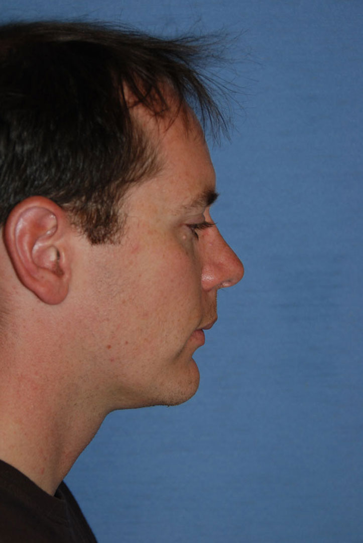 Chin Implant Before & After Photo