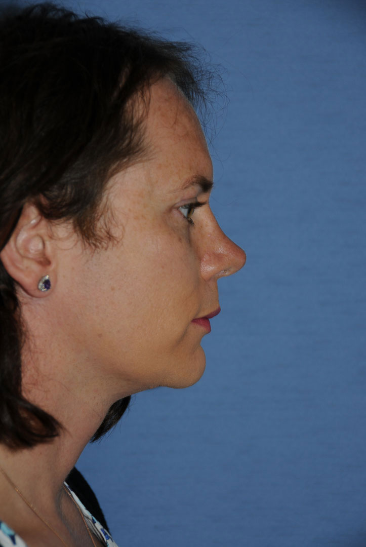 Chin Implant Before & After Photo