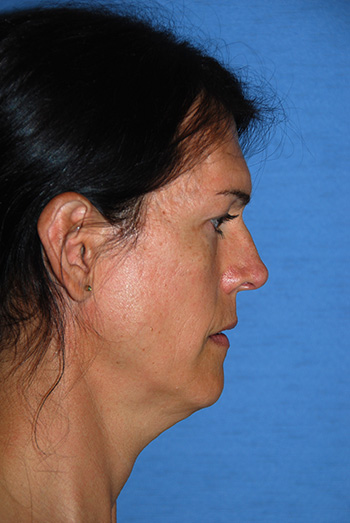 Chin Implant Before & After Photo