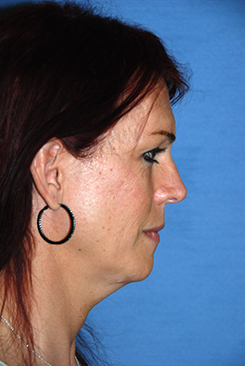 Chin Implant Before & After Photo