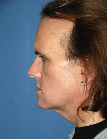 Chin Implant Before & After Photo