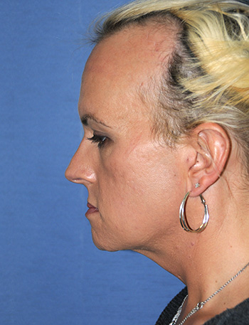 Chin Implant Before & After Photo