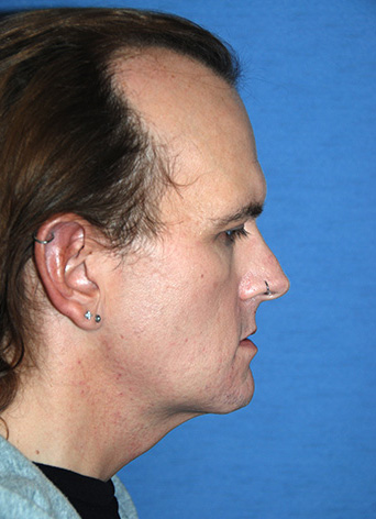 Chin Implant Before & After Photo