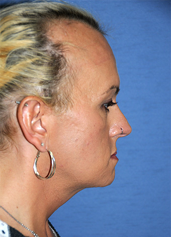 Chin Implant Before & After Photo