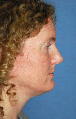 Chin Implant Before & After Photo