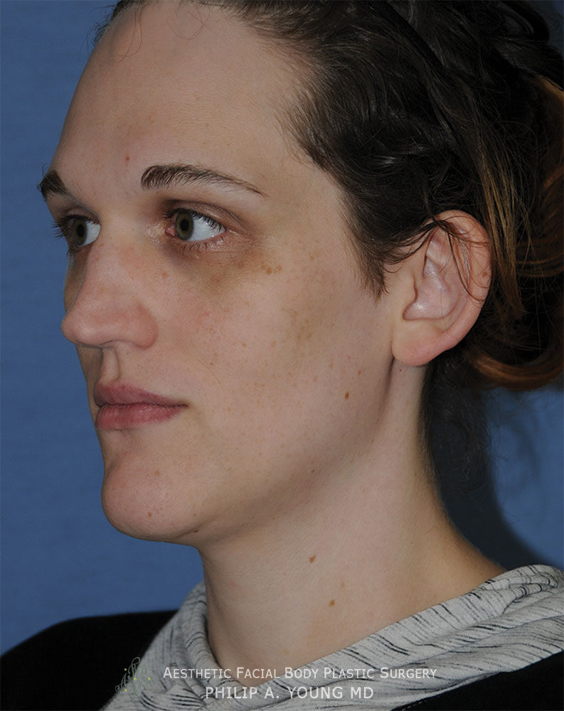 Chin Implant Before & After Photo