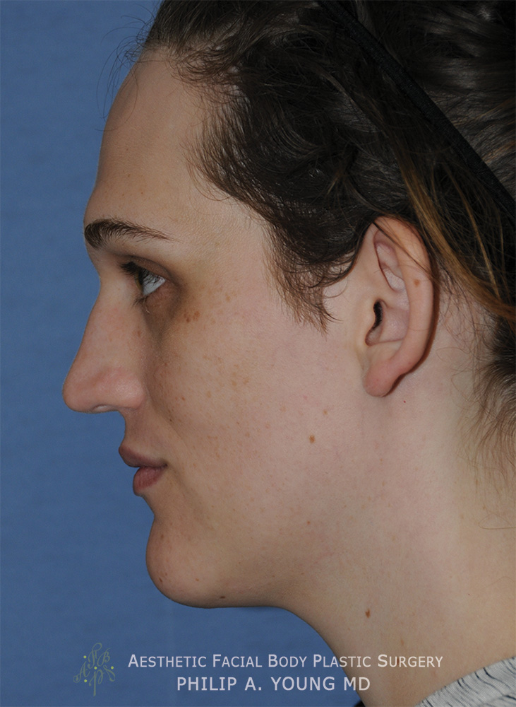 Chin Implant Before & After Photo