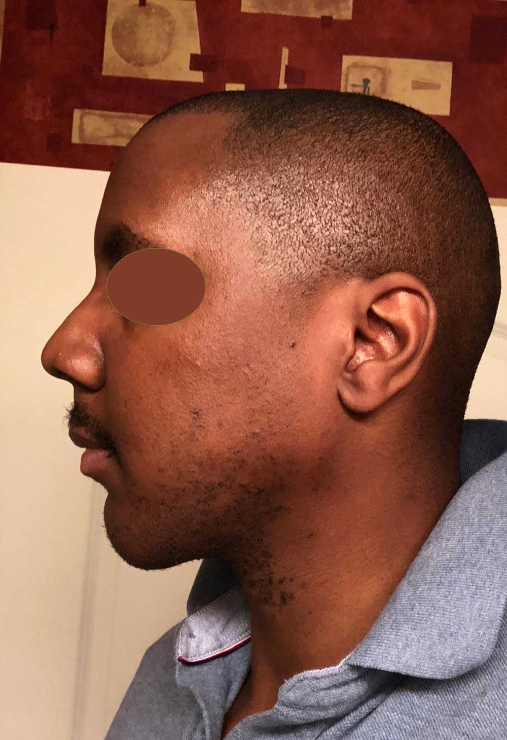 Chin Implant Before & After Photo