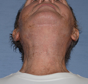 Facelift Before & After Photo