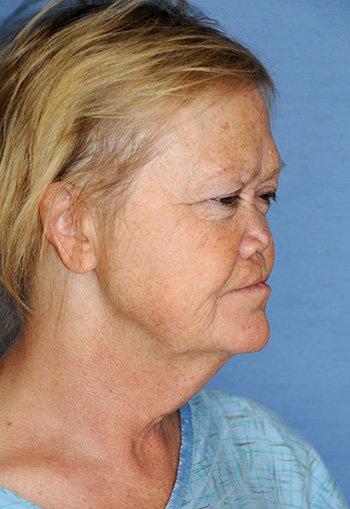 Facelift Before & After Photo