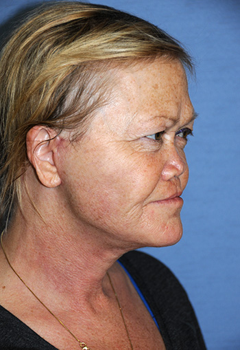 Facelift Before & After Photo