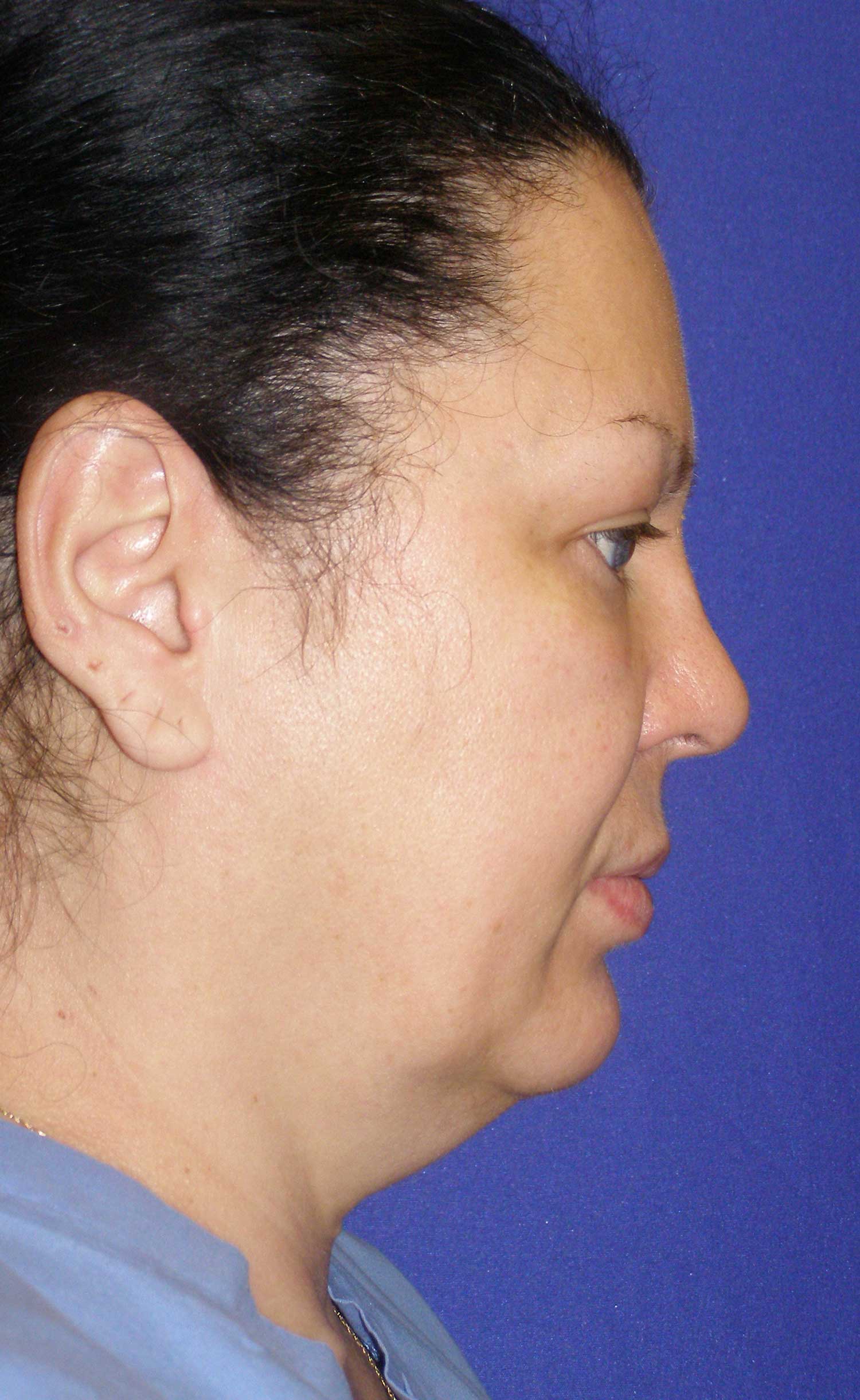 Neck Lift Before & After Photo